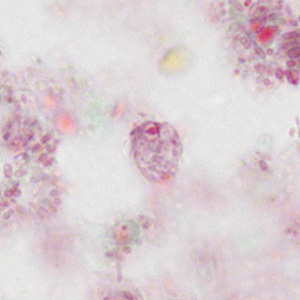 A 42-year-old photographer, who is known to travel to remote locations in tropical regions, presented to her health care provider with mild, intermittent abdominal cramping and low grade fever.