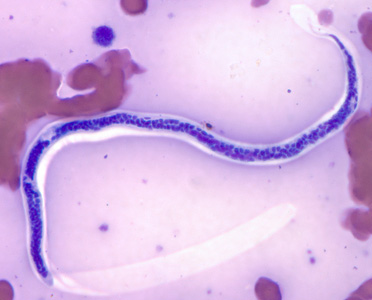 November - 2011 - Case #311 A 55-year-old homebound Type II diabetic, originally from Haiti, was hospitalized for severe abdominal pain and hematemesis.