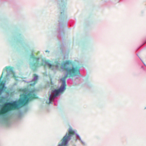A 27-year-old patient with multiple myeloma presented with respiratory problems and disseminated lesions over various parts of his body post stem-cell transplant. 