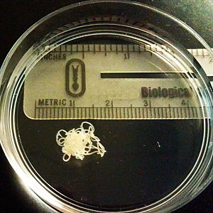 December - 2011 - Case #314 A 25-year-old man sought medical attention for a nodule on his right hand that had developed about a year after returning from travel to Liberia.