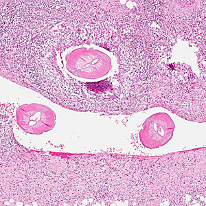 February - 2012 - Case #317 A 55-year-old woman sought medical attention for a nodule on the right side of her head. The patient presented with pain on the right side of her head for the past two months.