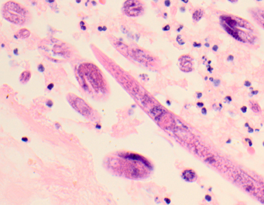 March - 2012 - Case #319 A 65-year-old patient was admitted to the hospital with fever, nausea, and vomiting after recently being treated as an outpatient for a urinary tract infection.