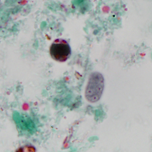 Stool specimens were collected from Haitian refugees as part of a screening program for intestinal parasites. Stool was collected in polyvinyl alcohol (PVA) and 10% formalin and sent to the county public health lab for routine ova-and-parasite (O&P) examination.