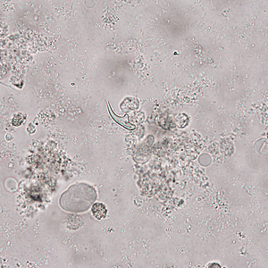 April - 2012 - Case #321 A 55-year-old man from the Middle East presenting with chronic abdominal pain was seen by his health care provider.
