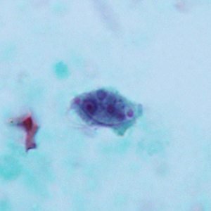 A 28-year-old man presented to his health care provider with intermittent diarrhea, mild abdominal cramping, and low-grade fever. 