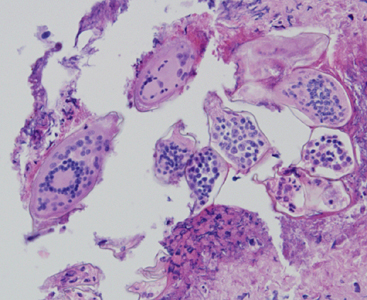 May - 2012 - Case #324 A 58-year-old female who had emigrated from Africa was seen by her health care provider for complications with squamous cell carcinoma of the cervix.