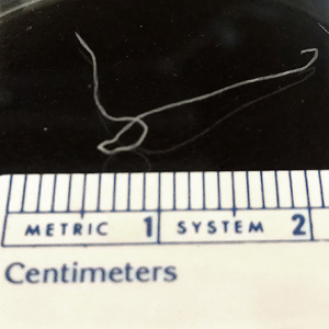 A 26-year-old man was seen by his health care provider for the sensation of something moving in his mouth. He reported a history of such sensations since he was age 12. 