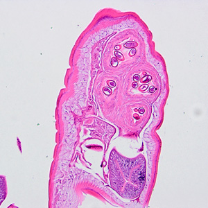 A 65-year-old female, who lives in northern California, had a colonoscopy performed as part of a routine screening. A foreign body was observed and subsequently removed.