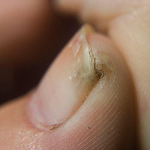 July - 2012 - Case #328 A 25-year-old woman traveled to Kenya and Uganda for three months of field work in public health entomology. Upon returning to the United States, she noticed a painful lesion on her left big toe.