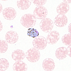 August - 2012 - Case #330 A 36-year-old man sought medical attention for sharp recurring episodes of fevers, night sweats, loss of appetite and weight-loss. He was HIV-positive but was currently on medication.