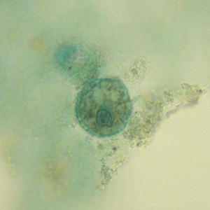 A 35-year-old woman, who had emigrated from Azerbaijan five years previous, presented to her health care provider with abdominal pain. 