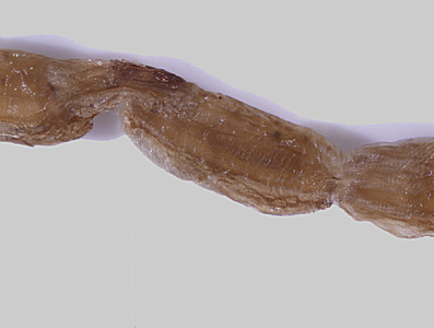 A 55-year-old man presented with complaints of abdominal pain, constipation, intermittent diarrhea with blood and mucus, and blurry vision accompanied by headaches. 