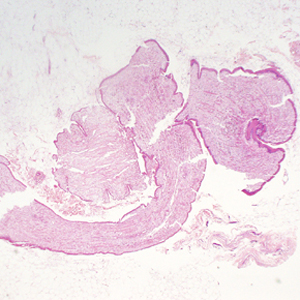 A 68-year-old woman underwent a routine screening mammogram, which revealed calcifications in the right breast. Biopsy specimens were collected and sent to Pathology for histological work-up.