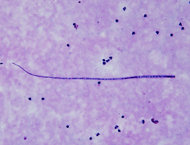 January - 2013 - Case #339 The CDC conducted a survey with the Ministry of Health in Uganda to evaluate the prevalence of filariasis among the local population. Skin snips and blood specimens were collected and sent to a regional laboratory for preparation.