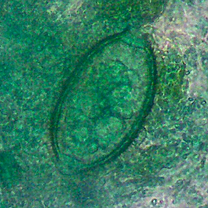 March - 2013 - Case #343 Stool specimens were collected from residents of the Peruvian Amazon rain forest to evaluate the burden of helminth infections. Stool was collected and processed via Kato Katz at a laboratory in Cusco, Peru.