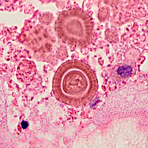 An 83-year-old man presented to a medical institution with shortness of breath and left flank pain that developed during a trip to Mexico shortly beforehand. Magnetic resolution imaging (MRI) revealed an exophytic mass on his left kidney.