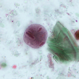 April - 2013 - Case #346 A 21-year-old exchange student from Nepal sought medical attention for intermittent diarrhea associated with mild abdominal cramps. A stool specimen was collected for laboratory testing in low viscosity polyvinyl alcohol (LV-PVA).