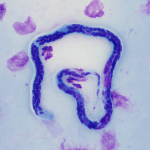 Random night blood specimens were collected from over 500 subjects in an area endemic for lymphatic filariasis in coastal India. Roughly one-third of the cases were symptomatic, with or without recurrent episodes of fever and various degrees of lymphedema. 