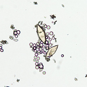 A 59-year-old foreign correspondent sought medical attention from his health care provider for intermittent hematuria which had started while on an assignment in Malawi. A urine specimen was collected, concentrated by centrifugation, and examined microscopically.