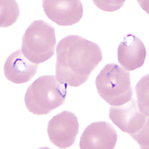 June - 2013 - Case #350 A 45-year-old man with travel history to Ghana presented to his health care provider with recurrent fever and chills. He admitted to not taking any kind of malaria prophylaxis during his travels.