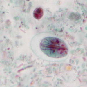 A nine-year-old child returned from summer camp in the mountains of North Carolina with complaints of abdominal pain, gas, and intermittent diarrhea. His parents took him to the family practitioner, who collected stool in Zn-PVA and 10% formalin for a routine ova-and-parasite (O&P) examination. 