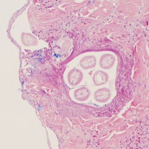 A 60-year-old Canadian presented to his health care provider with recurrent subcutaneous swellings in his posterior chest. The only travel outside of Canada reported in the last year was to Florida. Biopsy specimens were taken and sent to Pathology for routine histological work-up. 
