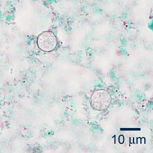 A 27-year-old man sought medical assistance for gastrointestinal symptoms that included watery diarrhea, abdominal pain, and fatigue. He reported no international travel within the last year. 