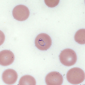 August - 2013 - Case #354 A 54-year-old male from Pennsylvania presented to his health provider with fever, chills, malaise, and loss of appetite. The patient was originally from Mexico but has been living in the eastern U.S. for the past several months.
