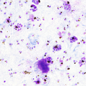 A 59-year-old man required emergency medical attention due to hyperpyrexia (>40° C/104° F), generalized convulsions, and signs of renal failure. The patient's recent travel history was not available. 