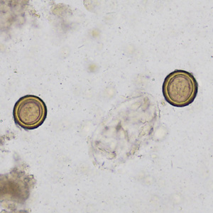 A 26-year-old female college student had undergone a homeopathic regimen advertised to eliminate parasites from the body. The only travel reported was to Maine a year ago to live with relatives on a farm between semesters. 