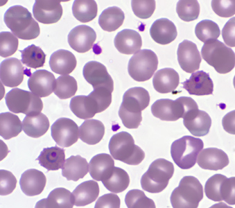 A 19-year-old female presented to the emergency room with fever, chills, and nausea on a 48-hour cycle. She had travel history to the Bahamas and Tanzania, but has not been abroad for nearly nine months. 