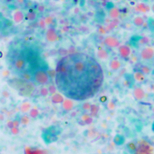 November - 2013 - Case #360 A county health department in Kansas routinely collects stool specimens as part of their refugee screening program. Stool is collected in 10% formalin and zinc-PVA (Zn-PVA) and forwarded to the state health laboratory for ova-and-parasite (O&P) examination.