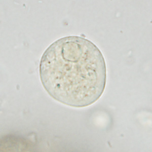 A 27-year-old man in the U.S. Army, who had been stationed overseas in southeast Asia, sought medical attention for nausea, vomiting, and intermittent diarrhea. 