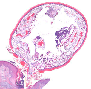 January - 2014 - Case #364 An 81-year-old man, with a previous history of basal-cell carcinoma on his upper right arm and shoulder, presented with a small protuberance in the hollow of his left knee.