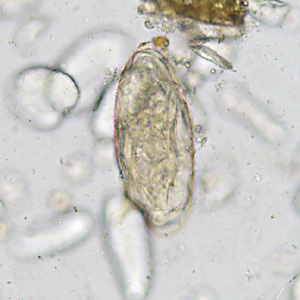 A 21-year-old immigrant from North Africa had a routine ova-and-parasite (O&P) stool exam performed as part of a refugee screening program. 