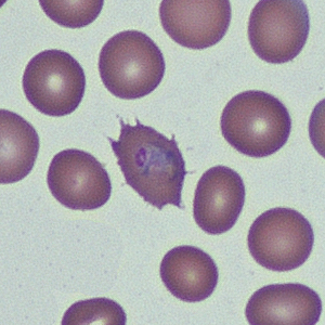 March - 2014 - Case #368 An eight-year-old child presented to a hospital with intermittent fevers. He had recently returned from a trip to Kenya and had not taken anti-malarial prophylaxis while traveling.