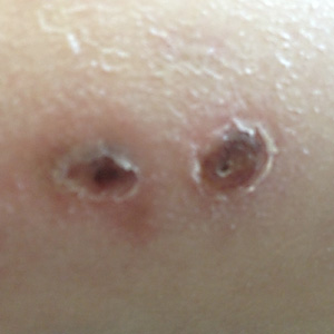 A 24-year-old male with a history of granulomatous immunodeficiency had biopsy specimens taken of skin lesions on his right forearm. 