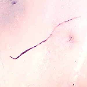 April - 2014 - Case #370 A 21-year-old female presented with swelling of the eyelid, wrist, and knee. The symptoms started after returning from a three-month trip to Cameroon in 2011.