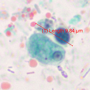 Stool specimens were collected from a 14-year-old refugee from Myanmar as part of a routine screening program. The stool was collected in 10% formalin and zinc PVA (Zn-PVA) and sent to the state health laboratory for ova-and-parasite (O&P) examination.