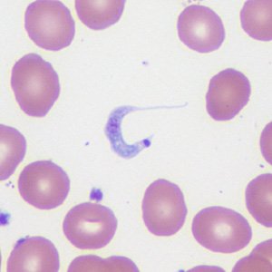 May - 2014 - Case #372 A 45-year-old patient originally from Mexico presented with a left groin lymphocele, erythema, swelling in his lower extremities, and fever and chills approximately one month after receiving a heart transplant.