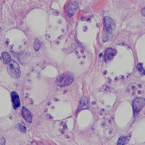 A 25-year-old female presented to a dermatologist with ulcerative lesions on her left arm and both lower legs.  She had traveled to Panama three months prior. 
