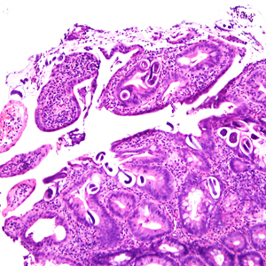 A 25-year-old male was hospitalized for Crohn’s exacerbation, duodenal outlet obstruction, and regional enteritis. He indicated that he has not had recent travel abroad. 