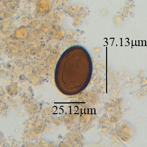 A man was seen as an outpatient at a hospital in Atri, Italy. A stool specimen was collected and processed for ova-and-parasite (O&P) testing. Images of suspect parasites were taken and sent to the DPDx Team for diagnostic assistance. 
