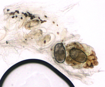 November - 2014 - Case #383 A patient presented to a local hospital with encrusted lesions on his arms and legs. A skin scraping was made and examined unstained at 40x magnification.