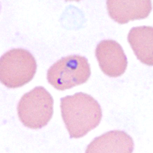 A 10-year-old girl residing in Pennsylvania was hospitalized with a 101.5º F fever, vomiting, abdominal pain, and diarrhea. The patient had recently returned from visiting family in West Africa. 