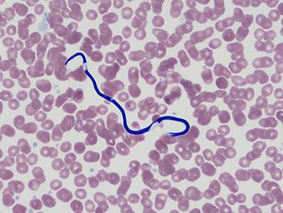 A 55-year-old refugee from the Democratic Republic of Congo demonstrated 23.9% eosinophilia with the presence of suspect microfilaria on Wright-Giemsa stained peripheral blood smears. 