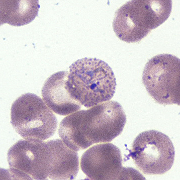 March - 2015 - Case #392 A 39-year-old male, originally from Fiji, presented to a hospital in Pohnpei, Federated States of Micronesia (FSM) with fever, chills, and head and body aches.