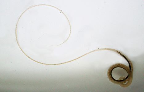 April - 2015 - Case #393 A 59-year-old female immigrant presented at a local hospital with microcytic/hypochromic anemia and eosinophilia.