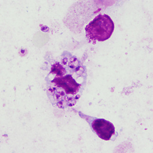A 17-year-old female presented with a crusted nodule on her left cheek two months after traveling to Israel.  