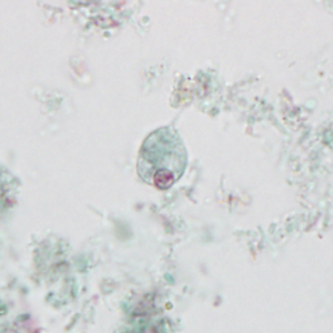 Stool specimens were collected from an asymptomatic 12-year-old boy from Myanmar as part of a refugee screening program. The stool was collected in 10% formalin and zinc PVA (Zn-PVA) and sent to the county health department for routine ova-and-parasite (O&P) examination. 